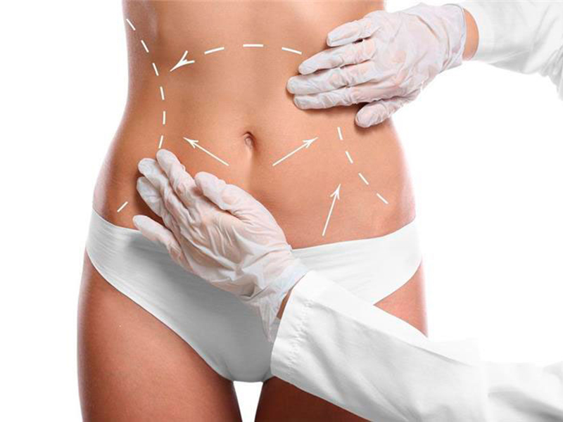 Liposuction (yağ aldırma)